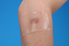 removal scar repeat use ISO/CE Silicone Scar Dressing