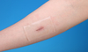 High Absorbency eco- friendly Silicone Scar Dressing for healed trauma wounds