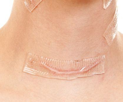 FDA approved High Quality Silicone Scar Dressing with ISO CE